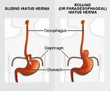 How Do Doctors Check For Hernia Images