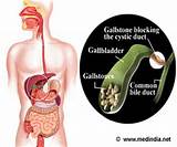 Gallstones Diagnosis And Treatment Photos
