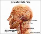 Photos of Central Post Stroke Pain Syndrome Treatment