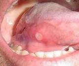 Images of Pimple On Tongue Treatment