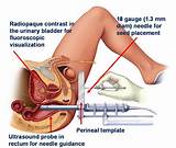 Radiation Seed Therapy Images