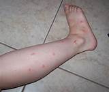Images of Mosquito Swelling Treatment