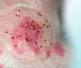 Photos of Termites Skin Rash