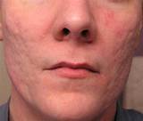 Best Acne Scar Fade Treatment