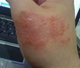 Photos of Eczema On Back Treatment