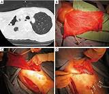 Images of Right Upper Lobectomy Recovery