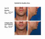 Photos of Kybella Injections Side Effects