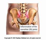 Images of Sacroiliac Joint Inflammation Treatment