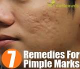 Pimple Spot Removal Home Remedies Images