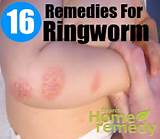 Home Remedies Ringworm Dogs Images