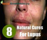 Images of Lupus Home Remedies Treatments