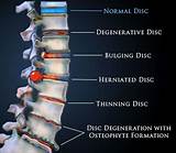 Laser Treatment For Bulging Disc Images