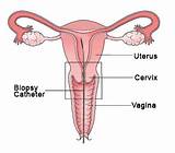 Images of Endometrial Biopsy Recovery