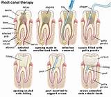 Pictures of Recovery After Root Canal