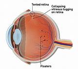 Images of Can Eye Doctors See Floaters