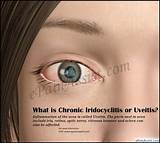 Pictures of Iridocyclitis Treatment