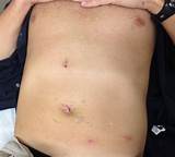 Images of Post Inguinal Hernia Surgery Recovery