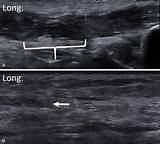 Intermetatarsal Bursitis Management