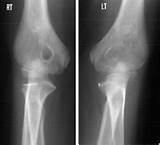 Congenital Radioulnar Synostosis Treatment Pictures