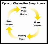 Pictures of Severe Obstructive Sleep Apnea Treatment