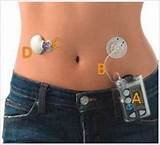 Pictures of Insulin Pump