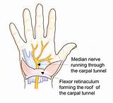 Median Nerve Damage Recovery Pictures