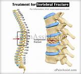 Photos of Fractured Vertebrae Surgery Recovery Time