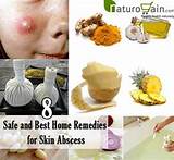 Images of Home Remedies Face Pack For Pimples