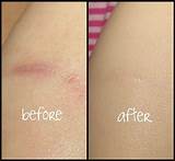 Acne Scar Home Remedies Fast Pictures