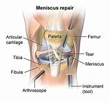 Meniscus Surgery Recovery Time Photos