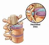 Herniated Extruded Disc