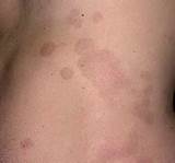 Laser Spot Removal Side Effects Images