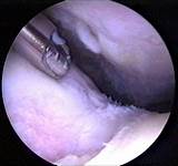 Images of Rehabilitation After Meniscus Surgery