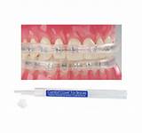 Pictures of Orthodontic Braces Cleaning Kit