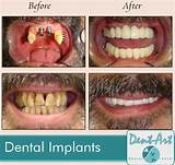 Cunning Dental Implants Images