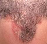 Photos of Eczema On Forehead Treatment