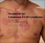 Advances In Lymphoma Treatment