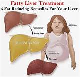 Fatty Liver Exercise Program Pictures