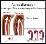 Medical Management Of Aortic Dissection Images