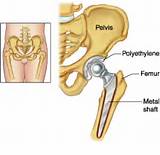 Muscle Strengthening After Hip Replacement