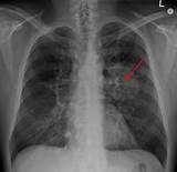 Signs Of Gas In Chest
