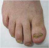 Foot Doctor For Nail Fungus Images