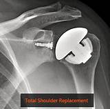 Shoulder Replacement Recovery Images