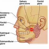Parotid Gland Home Remedies Pictures