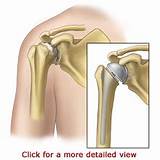 Pictures of Shoulder Joint Replacement Surgery Recovery