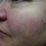 Photos of Spider Vein Laser Treatment How Long To See Results