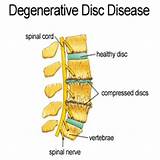 Therapy For Degenerative Disc Disease