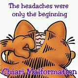 Images of Chiari Malformation Headache Treatment