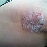 Pictures of Guttate Psoriasis Mayo Clinic