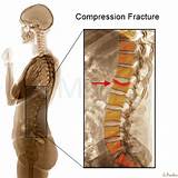 Pictures of Fractured Vertebrae Surgery Recovery Time